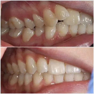 invisalign