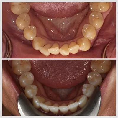invisalign