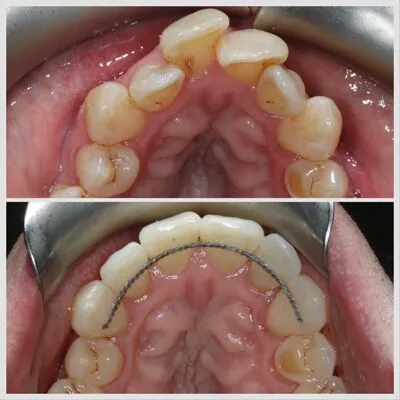 invisalign