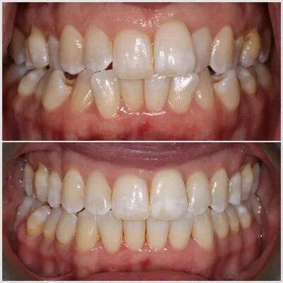 invisalign