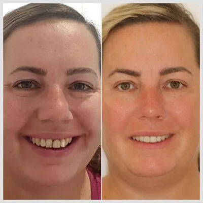 invisalign