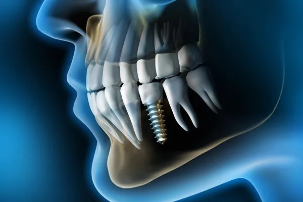 Dental Implants