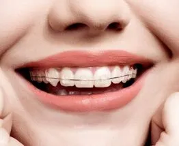fastbraces