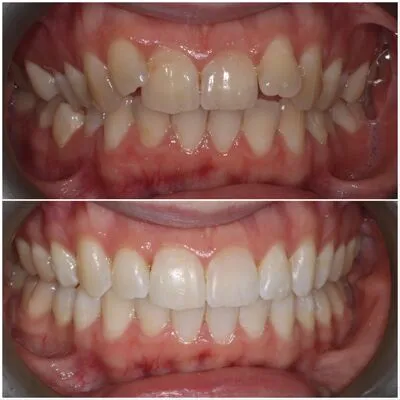 invisalign