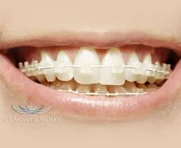 six month smiles