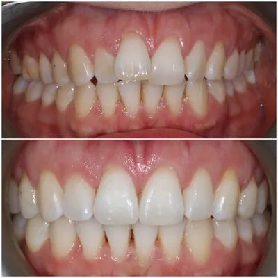 invisalign