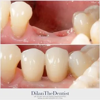 Implant