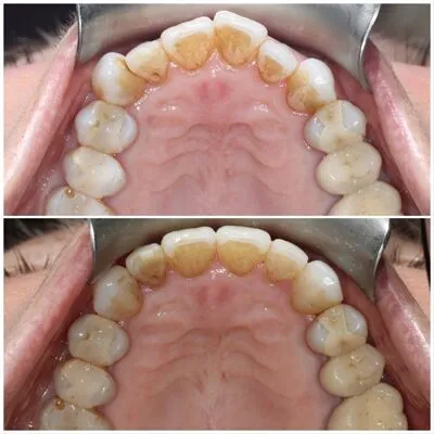 invisalign