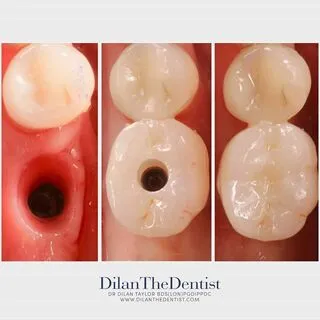 Implant