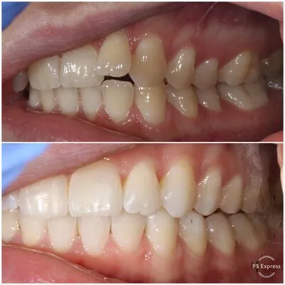invisalign