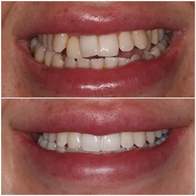 invisalign