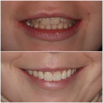 invisalign
