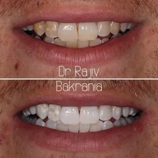 teeth whitening