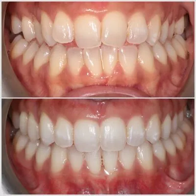 invisalign