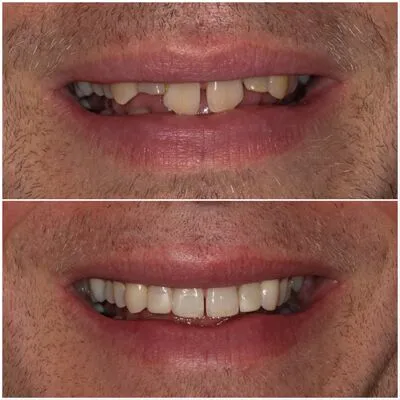 invisalign
