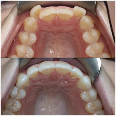 invisalign